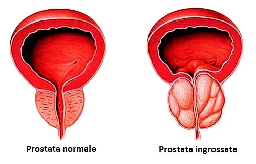 iperplasia-prostatica-benigna